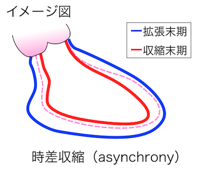 時差収縮（asynchrony）