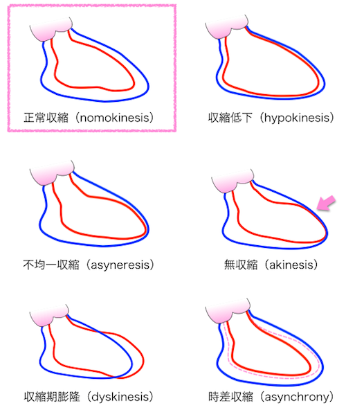 左室造影 LVG　評価