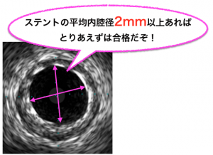 IVUS　ステント留置
