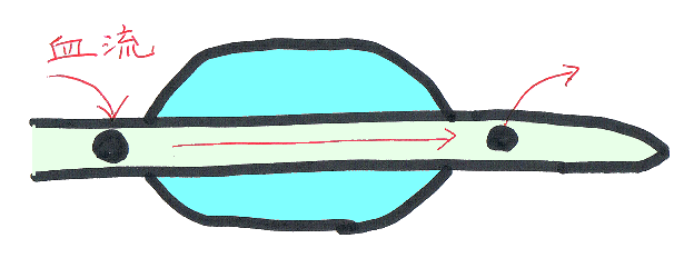 パーフュージョンバルーンカテーテルの構造