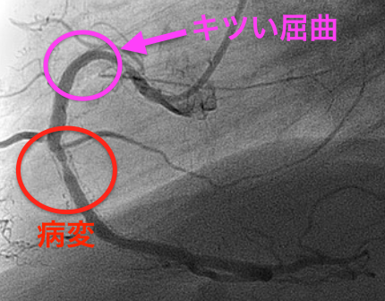カッティングバルーン通過性