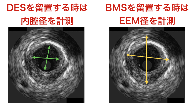 IVUS計測