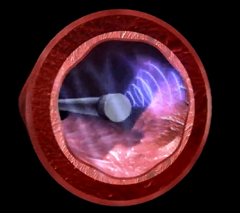 ivus
