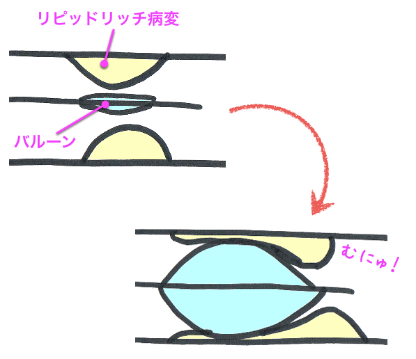 プラークシフト