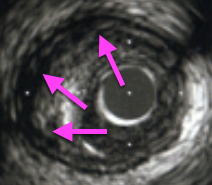 IVUSソフトプラーク