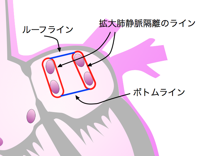 BOX isolation　左房後壁隔離術