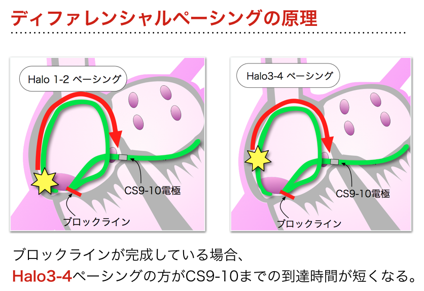 ディファレンシャルペーシングの原理