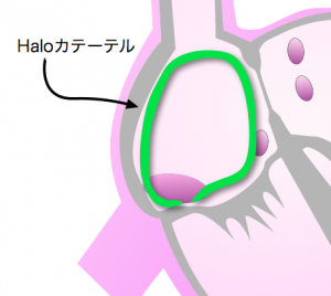 haloカテーテル