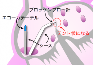 ブロッケンブロー法　心房中隔穿刺　テント状