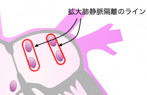 拡大肺静脈隔離術