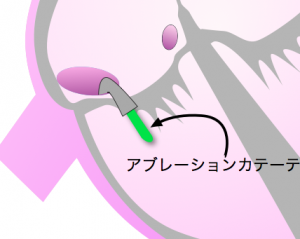 ablカテーテル