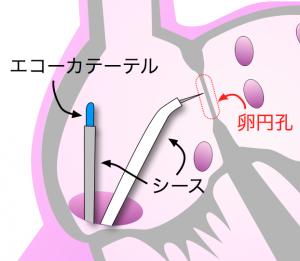 ブロッケンブロー法　心房中隔穿刺