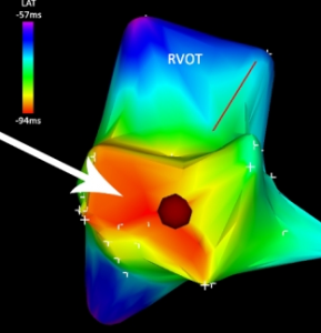 アクティベーションマップ