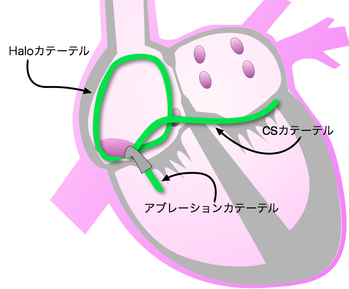 通常型心房粗動　カテーテルアブレーション