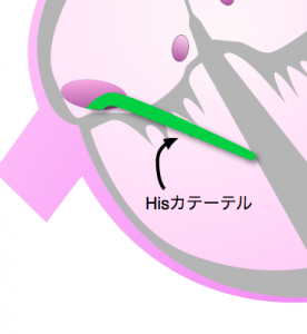 心房細動　hisカテーテル
