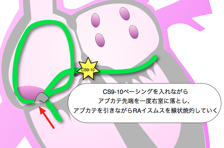 RAイスムス焼灼