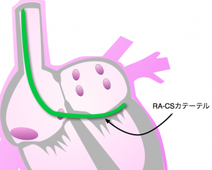 心房細動 csカテーテル