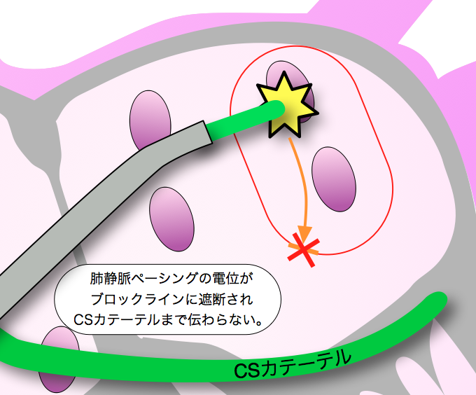 ABL pacing cs non capture
