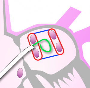 BOX isolation end point2