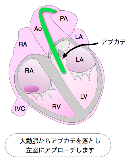 LVPVC ablation