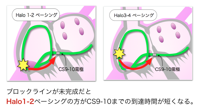 ディファレンシャルペーシングの原理２