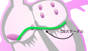 csカテーテル
