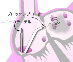 ブロッケンブロー法　心房中隔穿刺　造影