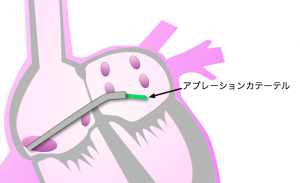 心房細動　アブカテ