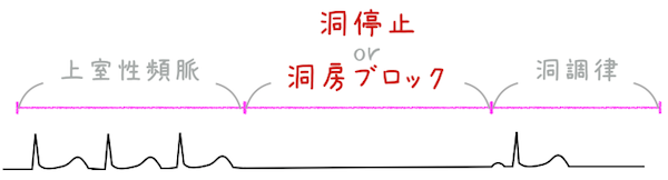 徐脈頻脈症候群　心電図
